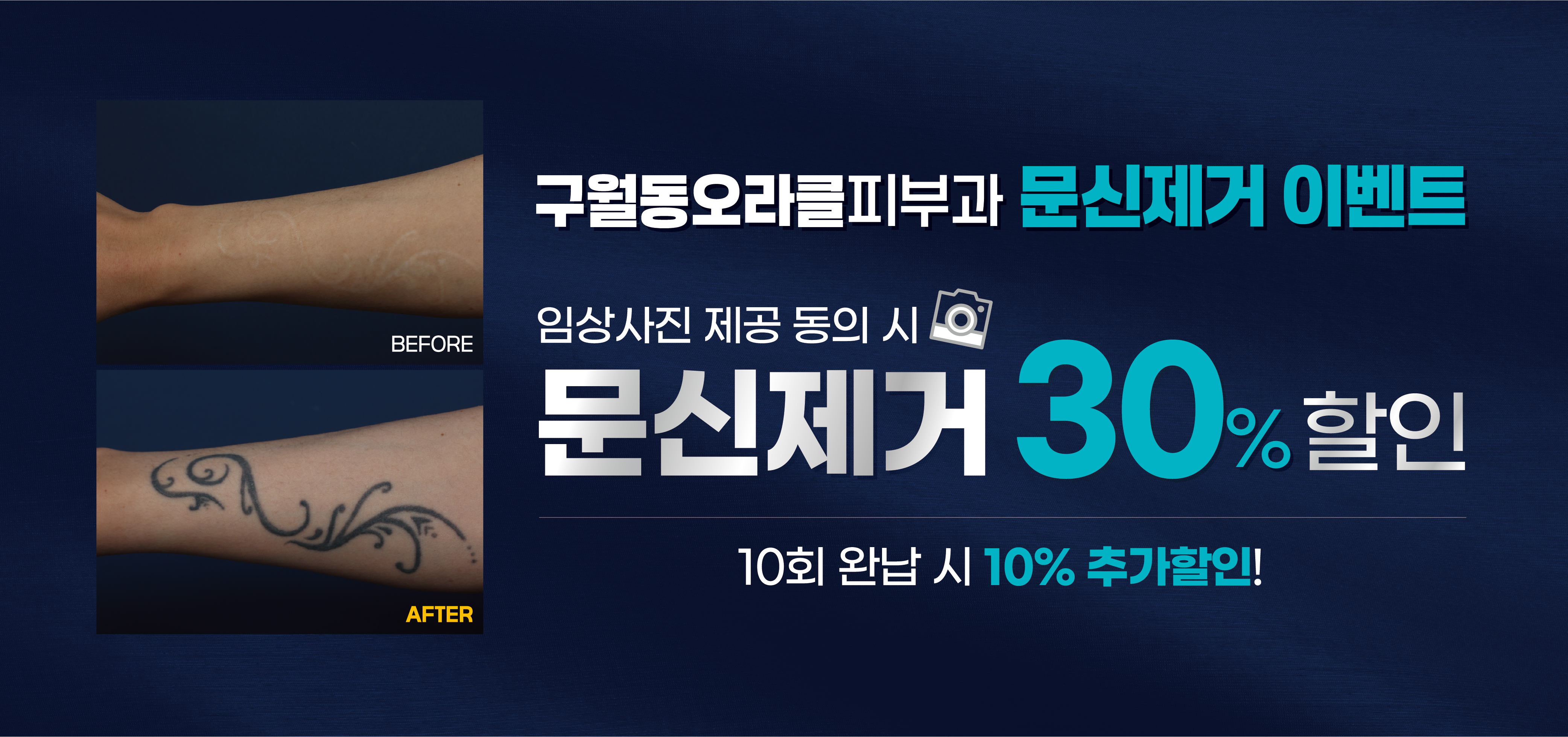 구월점 문신제거 이벤트