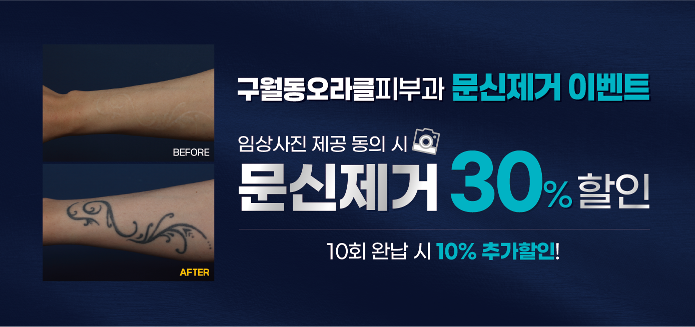 구월점 문신제거 이벤트
