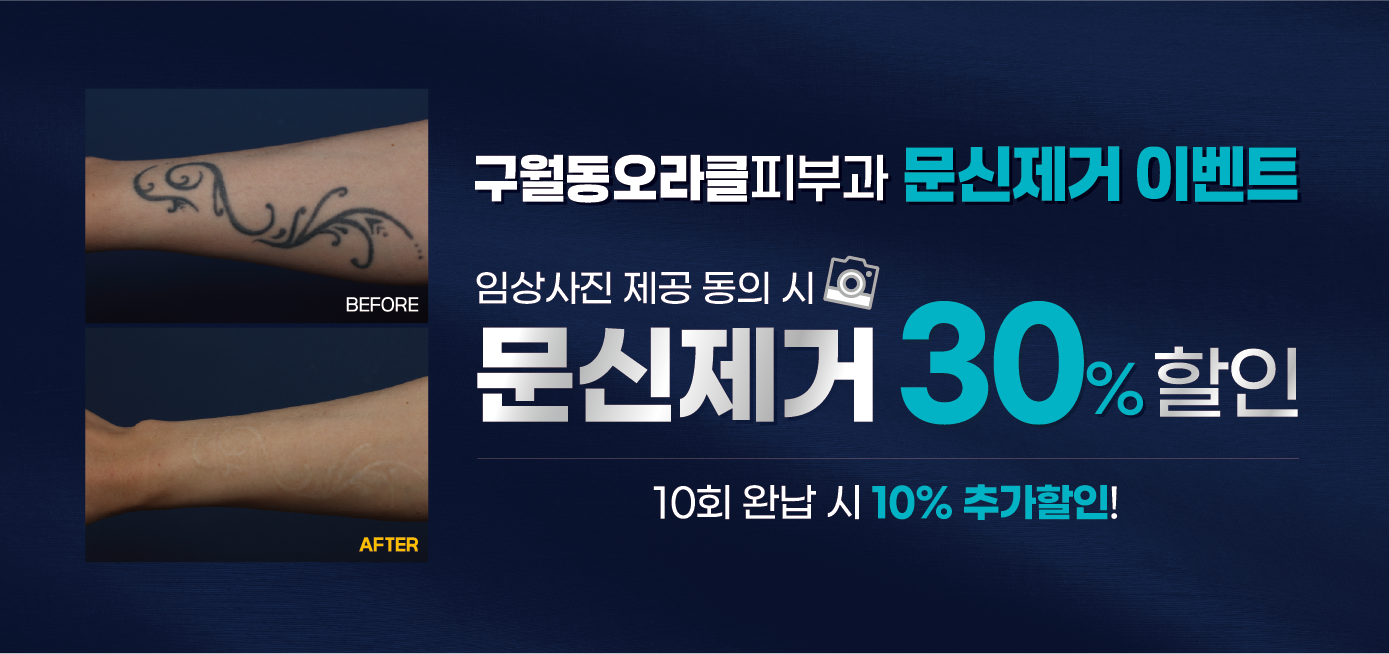 구월점 문신제거 이벤트