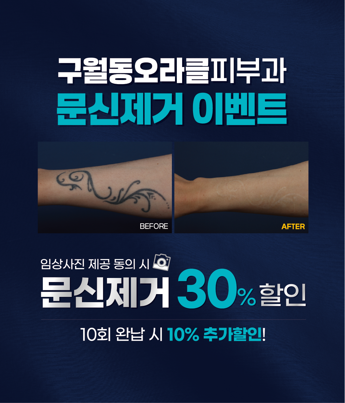 구월점 문신제거 이벤트